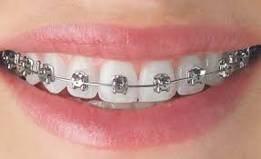 Dental Braces treatment at Dental Essential Panvel