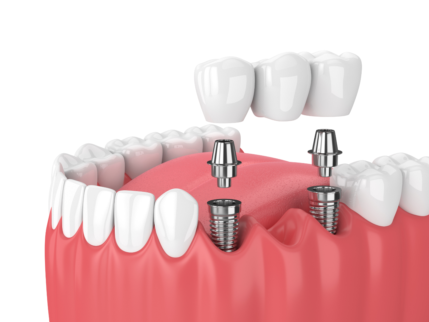 Dental Implants treatment at Dental Essential Panvel